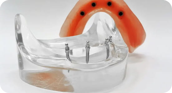 Miniimplantátumos fogsorrögzítés
