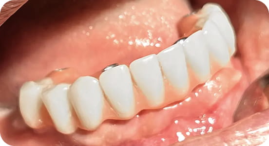 Stéges fogsor / Overdenture