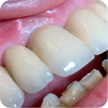 Stéges fogsor / Overdenture